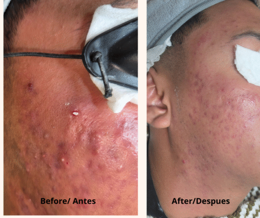 tratamiento anti acne