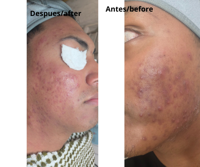 tratamiento anti acne