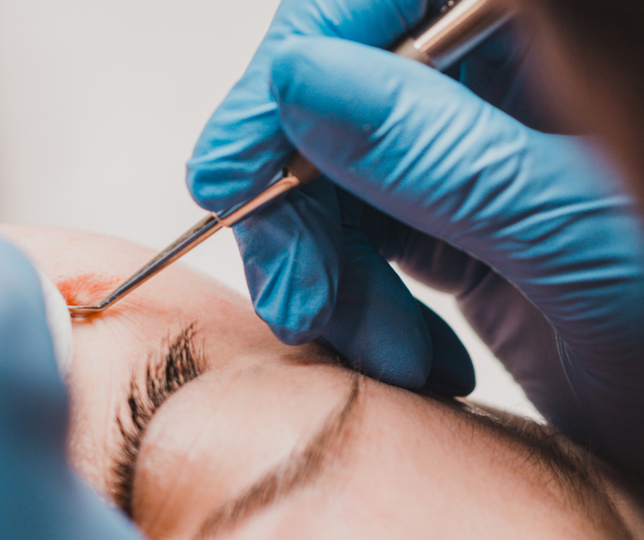 eliminacion de milia