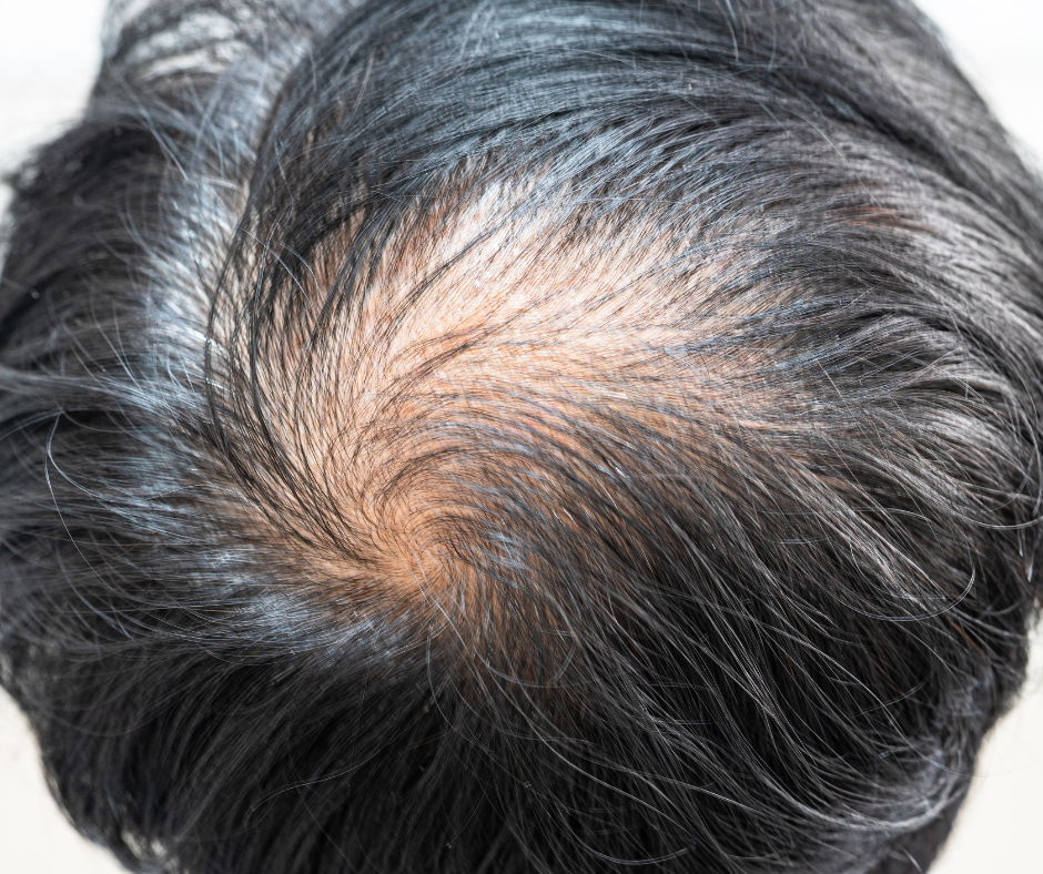 reconstruccion capilar