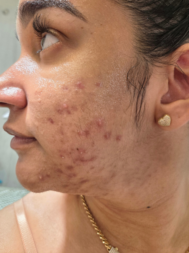 acne scar clifton,nj