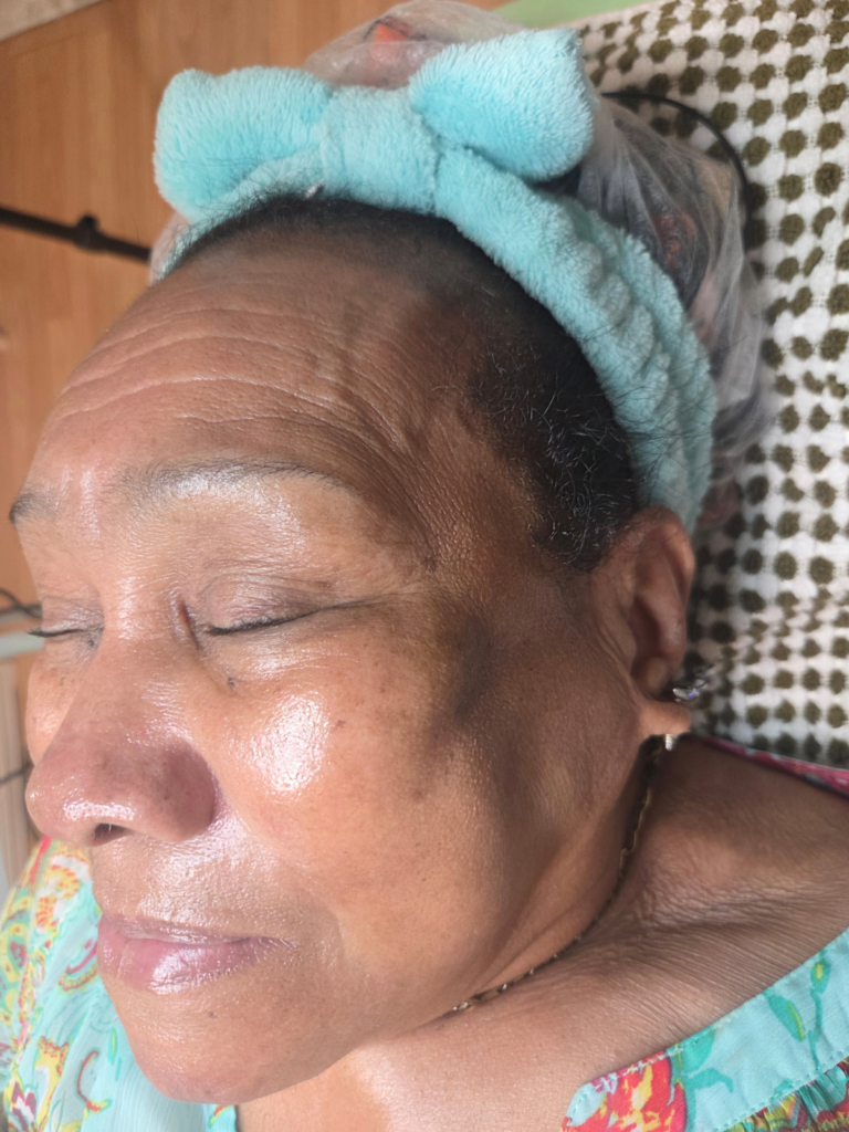rjuvenecimiento facial en clifton,nj