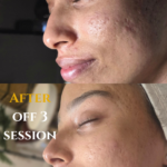 cicatrices de acne en clifton, nj