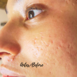 acne scar clifton nj