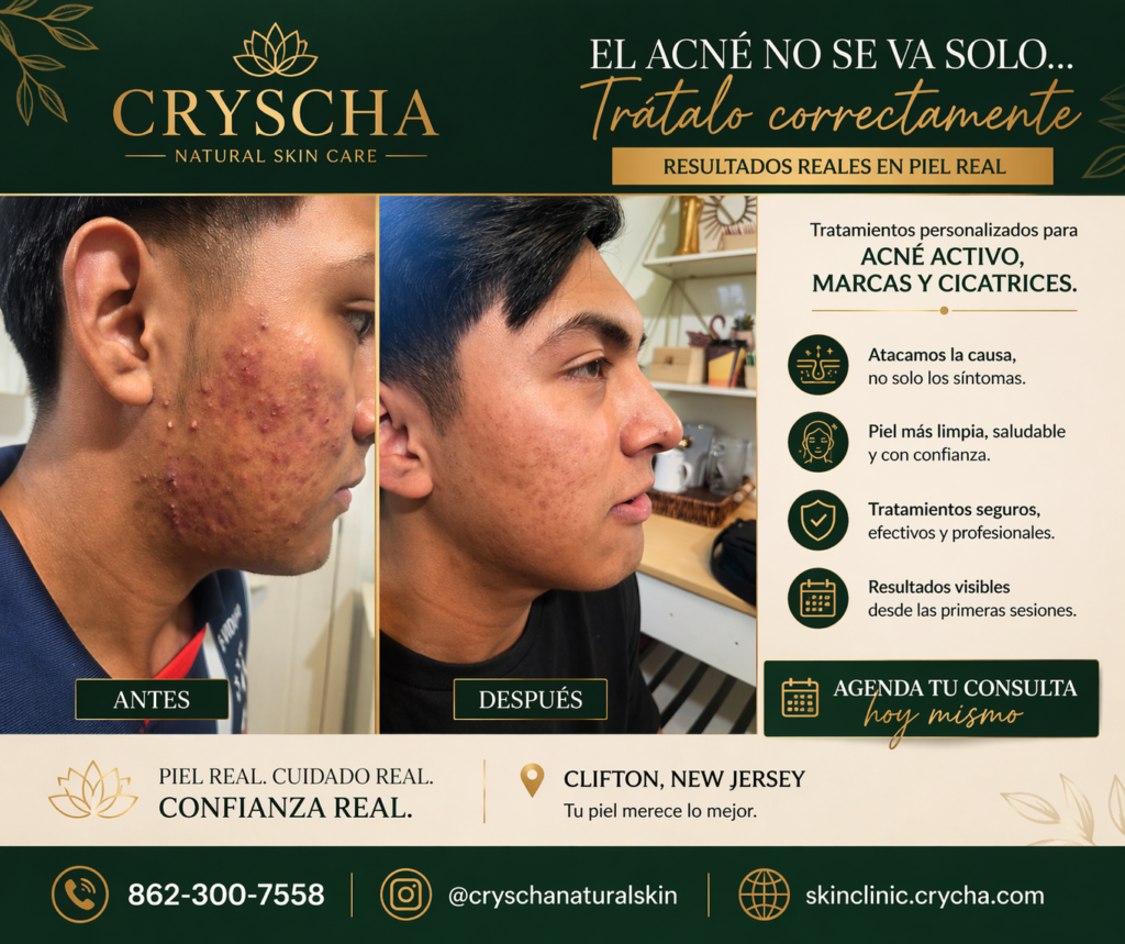 acne control clifton,nj