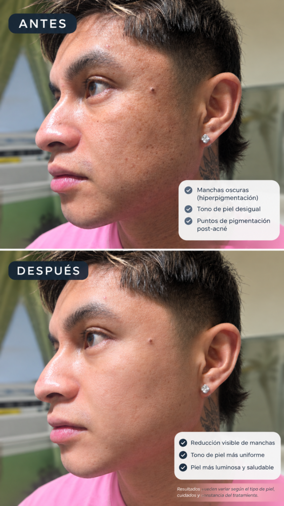 facial anti mancha,melasma hiperpigmentacion spot, en clifton,nj