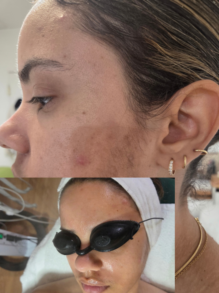 melasma clifton nj